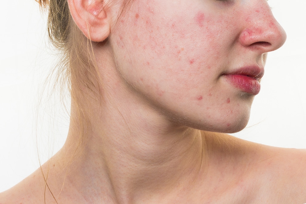 Imperfections don't have to stand in the way of a successful modelling career