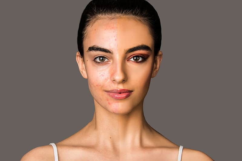 Half,Face,Acne,Skin,Problem,,Half,Face,Make,Up,Covered