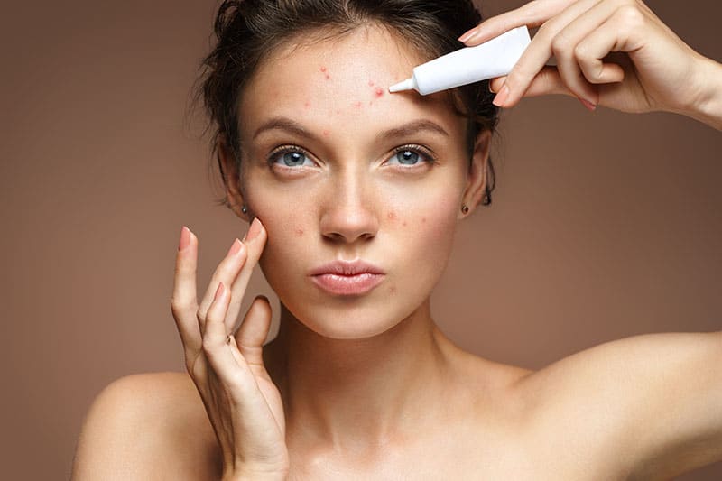 Supermodels with acne