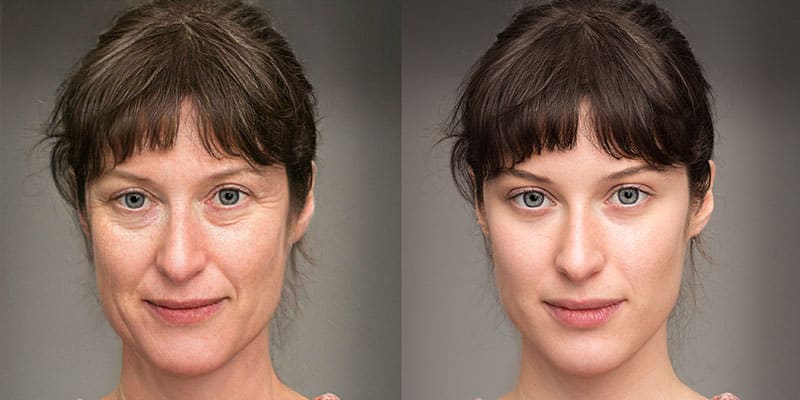 Same,Face,Of,Woman,Before,And,After,A,Rejuvenation,Treatment.